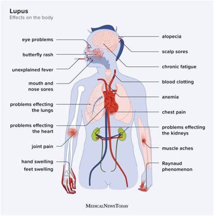 Can lupus cause difficulty walking?