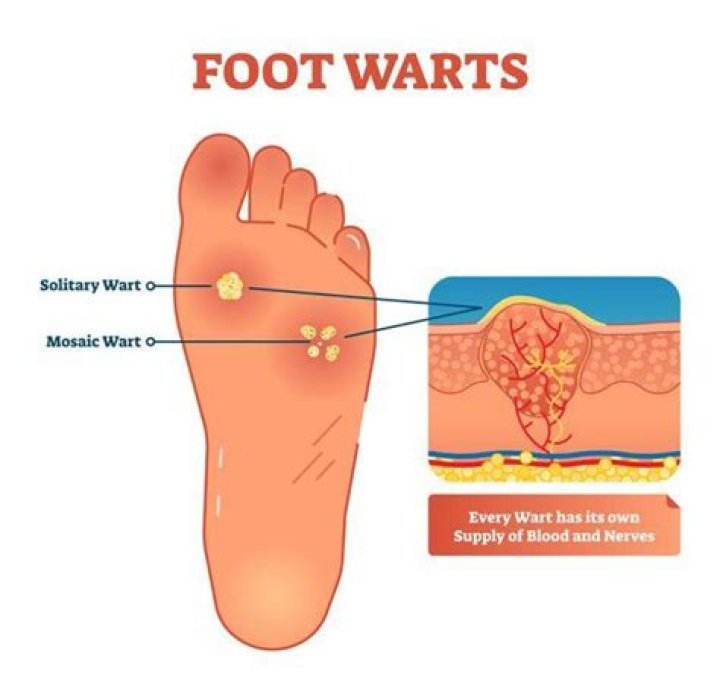 Do Plantars warts have roots?