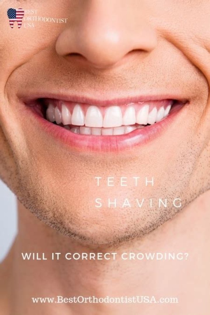 Do they shave your teeth after braces?