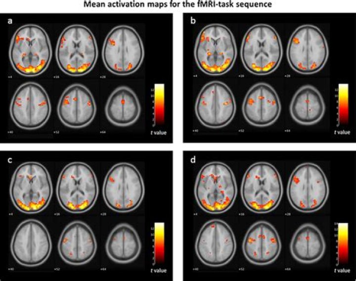 Does fibromyalgia show on an MRI?