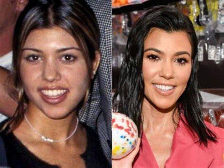 Does Kourtney Kardashian have silver teeth?
