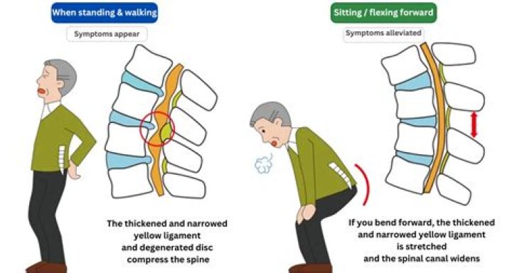 How does a person with spinal stenosis walk?