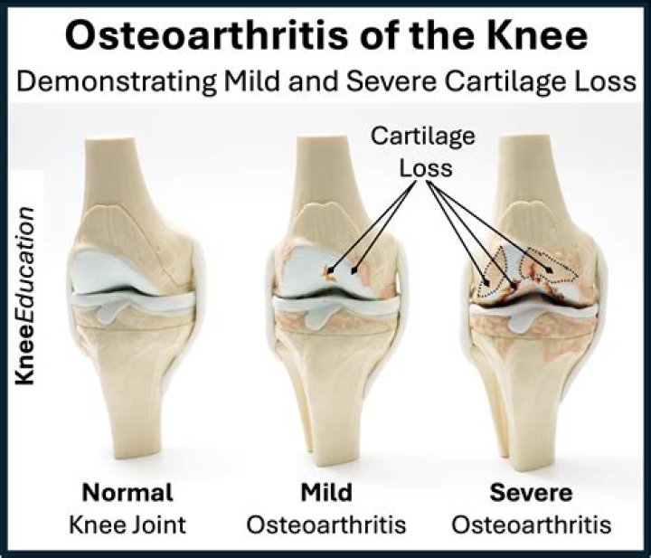 Is severe osteoarthritis a disability?