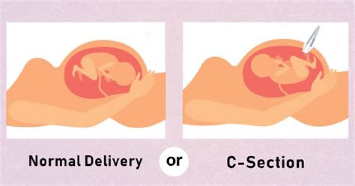 What's safer C-section or natural?
