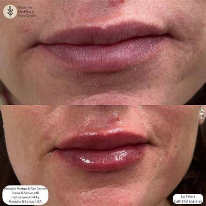 What can u eat after lip filler?