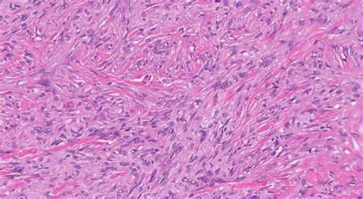 What is cellular fibrous histiocytoma?