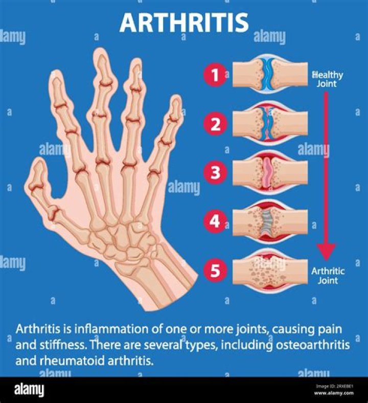 What type of arthritis is hereditary?