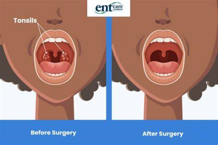 Will removing my tonsils stop snoring?